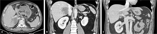 CT scan of the intrahepatic cholangiocarcinoma after chemotherapy. (A) Axial CT scan showing cholangiocarcinoma diameter reduction after chemotherapy and (B) and (C) coronal CT scan view of the vascular relation between the cholangiocarcinoma, IVC, and PV.