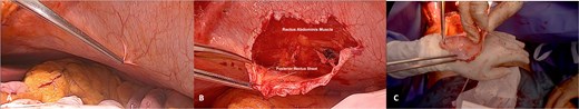 Harvesting of the autologous peritoneo-fascial patch. (A) Selecting of APFP harvesting site—in this case, the APFP was collected from the left hypochondrium; (B) dissection of the APFP between the rectus abdominis muscle and its posterior sheath; and (C) inspection of the harvested APFP.