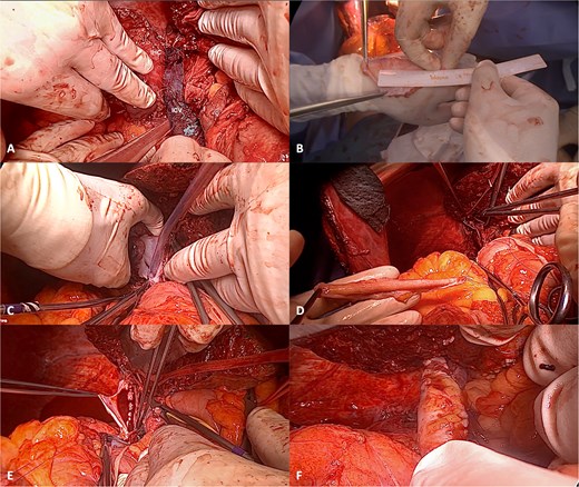 Reconstruction of the IVC with APFP. (A) Intrahepatic cholangiocarcinoma infiltrating the IVC; (B) after assessing the area of IVC resection, the APFP is measured and prepared; (C) following vascular clamping, tangential resection of the IVC anterolateral wall is performed; (D) traction sutures are placed at the borders of the APFP and the corners of the IVC; (E) the APFP patch is sutured using a running 4–0 polypropylene suture; and (F) the vascular clamp is removed, and the reconstructed IVC is inspected for bleeding and stenosis.