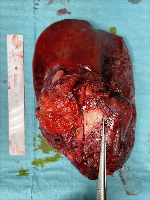 Final specimen. The resected specimen shows intrahepatic cholangiocarcinoma with invasion of the IVC.