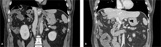 Reconstructed IVC and PV. (A) IVC and (B) PV 1 year after surgery.