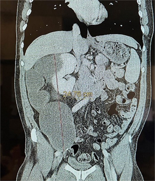 Coronal CT of the mucinous adenocarcinoma.
