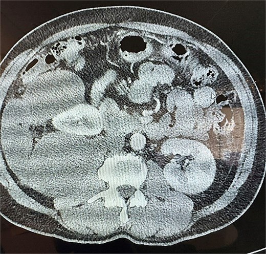 Transverse CT of the mucinous adenocarcinoma.