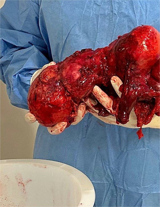 En bloc resected mass.