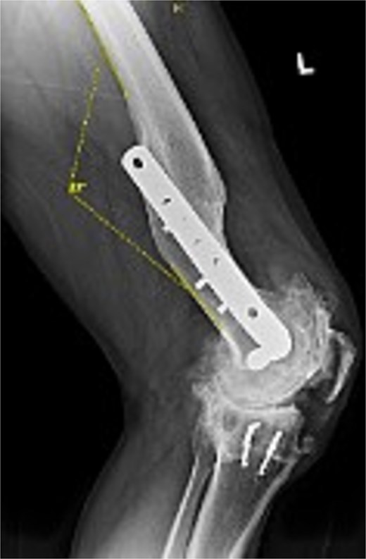 Preoperative lateral radiograph of the left knee and distal femur. The pre-existing lateral plate and screws are seen along the anterior femoral cortex. A pronounced recurvatum malunion of the distal femur is evident measured at 12°. The knee joint shows severe tricompartmental osteoarthritic changes with joint space obliteration and osteophyte formation.