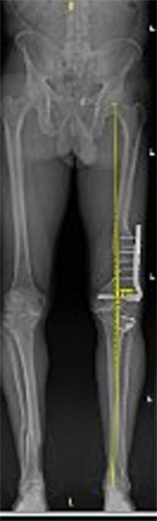 Preoperative standing AP radiograph of the patient’s lower extremities. The left femur has a lateral plate from a prior fracture. There is 3° varus alignment of the arthritic left knee. The femoral deformity is primarily in the sagittal plane, and the retained hardware is visible.