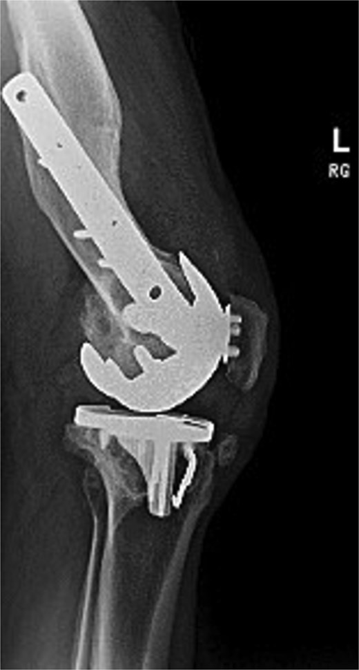 Postoperative lateral radiograph of the left knee 1 year after robotic-assisted TKA with hardware retention. The new femoral and tibial components are in place. The retained femoral plate and screws sit flush against the lateral cortex.