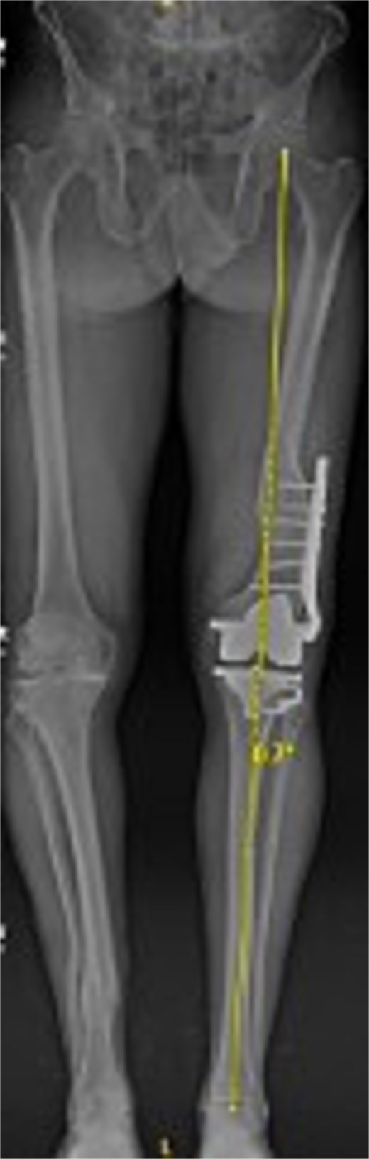 Postoperative AP bone length films 1 year after robotic-assisted TKA with hardware retention. The new femoral and tibial components are in place. The retained femoral plate is visible along the lateral cortex of the femur. Postoperative mechanical alignment of the left leg is 0.7°.