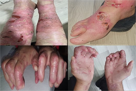 Ruptured sero-hemorrhagic blisters, eroded areas, inflamed, erythematous, fragile skin, some scarring mainly localized on upper and lower extremities, dystrophic nails, and contractures of hands and feet.