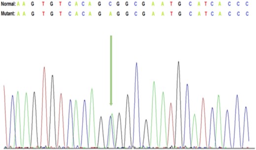 Representative Sanger DNA sequencing results showing the detection of c.373 C > A, p.(Pro125Thr) in exon 1 of the KRT17 gene.