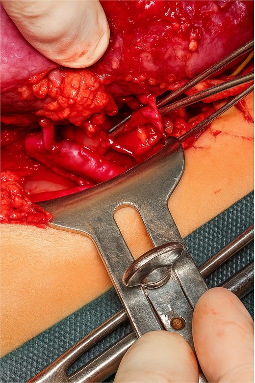 Anastomoses between the donor renal and recipient artery.