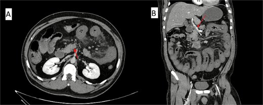 Contrast-enhanced abdominal CT scan showing acute mesenteric venous thrombosis. (A) Axial view demonstrating complete thrombosis of the superior mesenteric vein (arrow). (B) Coronal view confirming thrombus extension into the portal venous system (arrow).