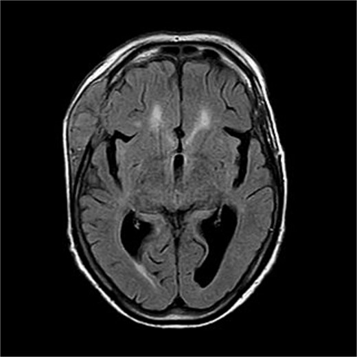 There is a bone lesion involving the right frontal bone and, to a lesser extent, the right greater wing of the sphenoid, with a sizable extracranial soft tissue component in the temporal fossa measuring 5 × 1.8 × 5.4 cm in CC, TV, and AP dimensions respectively. There is also a small related intracranial extra-axial soft tissue component with associated pachymeningeal mild thickening and enhancement over the frontotemporal cerebral convexity. No obvious brain parenchymal invasion is noted, No midline shift or brain herniation. There is generalized brain tissue volume loss in the form of prominence of sulci, gyri, and ventricular system. A tiny focus of blooming effect is noted at the right cerebellar hemisphere.