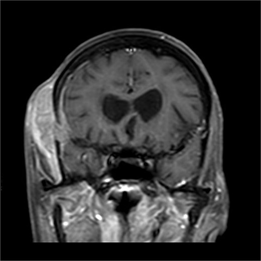 There is a bone lesion involving the right frontal bone and, to a lesser extent, the right greater wing of the sphenoid, with a sizable extracranial soft tissue component in the temporal fossa measuring 5 × 1.8 × 5.4 cm in CC, TV, and AP dimensions respectively. There is also a small related intracranial extra-axial soft tissue component with associated pachymeningeal mild thickening and enhancement over the frontotemporal cerebral convexity. No obvious brain parenchymal invasion is noted, No midline shift or brain herniation. There is generalized brain tissue volume loss in the form of prominence of sulci, gyri, and ventricular system. A tiny focus of blooming effect is noted at the right cerebellar hemisphere.