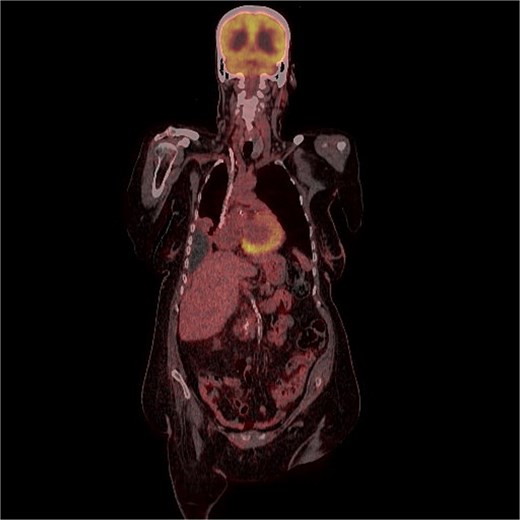 FDG uptake was noted in the scalp lesion, while no other areas of abnormal uptake were identified elsewhere.