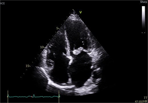 Transthoracic echo appearance of mitral valve with mass attached to posterior leaflet (apical 4 chamber view).