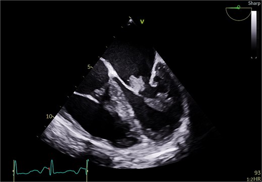 Transesophageal echo appearance of mass attached to posterior leaflet of mitral valve (mid esophageal 4 chamber view).