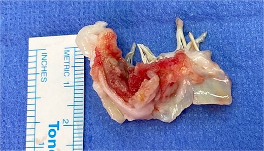 Operative view of mitral valve.