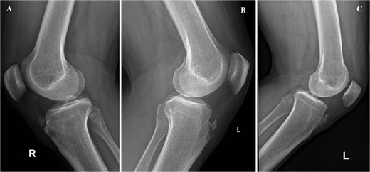 Preoperative lateral radiographs showing persistent tibial tubercle ossicles. (A) Right knee for first case. (B) Left knee for second case. (C) Left knee for third case.