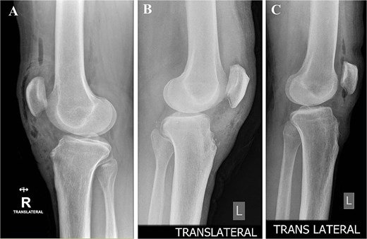 Postoperative lateral radiographs confirming complete excision and smooth tibial tubercle contour. (A) Right knee, case 1. (B) Left knee, case 2. (C) Left knee, case 3.