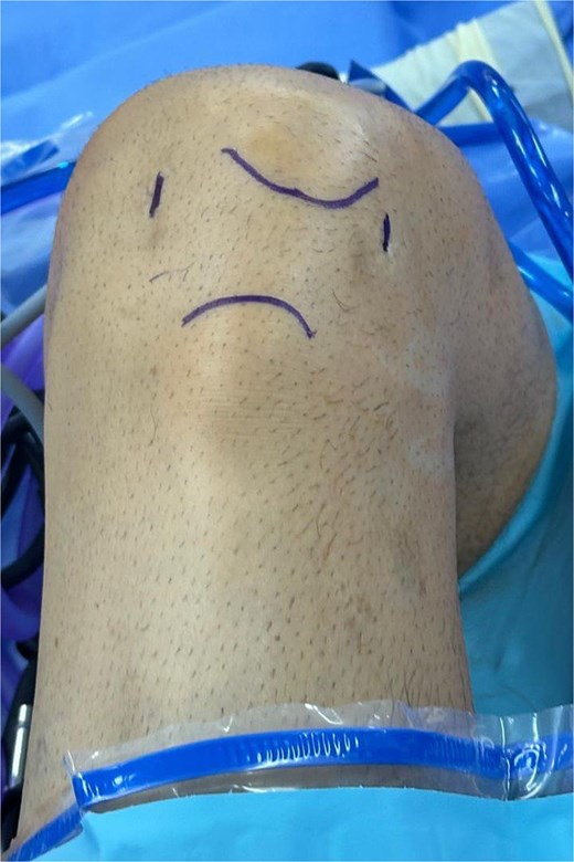 Intraoperative photograph showing arthroscopic portals marked for ossicle excision.