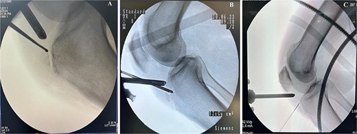 Intraoperative fluoroscopy views show ossicle before excision and complete removal. (A) Case 1. (B) Case 2. (C) Case 3, marking the position of the ossicle using arthroscopic spinal needle.