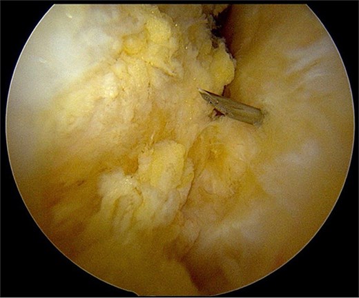 Marking the position with a spinal needle.