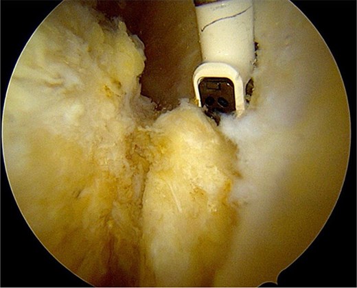Freeing the ossicle with a radiofrequency probe.
