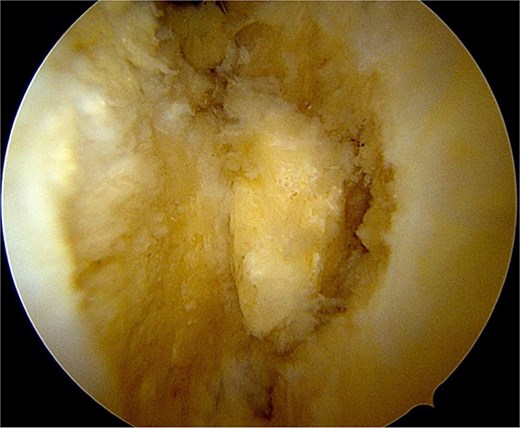 Freeing and mobile ossicle.