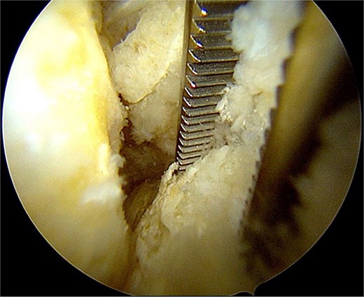 Removal of the ossicle.