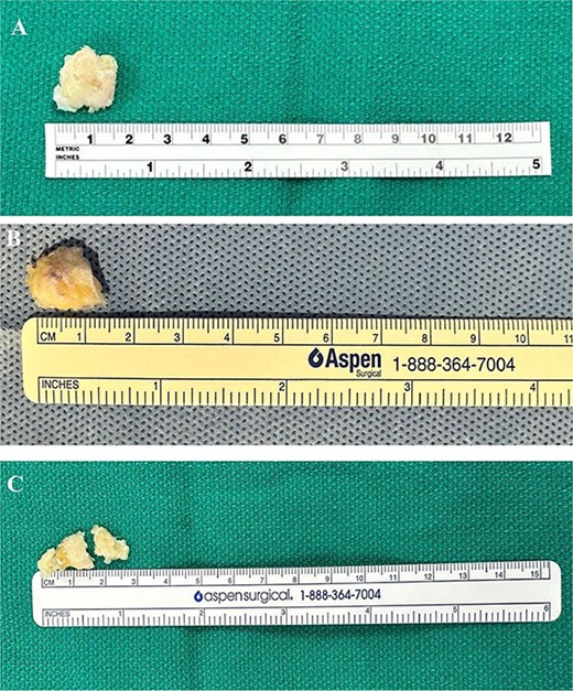Arthroscopic views of case 1. (A) Ossicle fragment removed. Case 2 (B) tibial tubercle leveling using an arthroscopic Burr. Case 3 (C) ossicle fragment removed.
