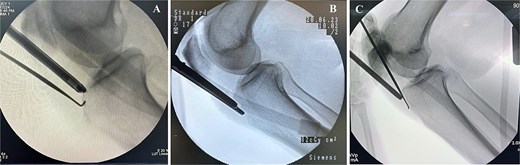 Excised ossicles following arthroscopic removal. (A) Case 1 specimen, measuring approximately 1.5 cm in greatest dimension. (B) Case 2 specimen, measuring ~1.5 cm in greatest dimension. (C) Case 3 specimen broken in two pieces to facilitate removal, measuring ~2.5 cm in greatest dimension.