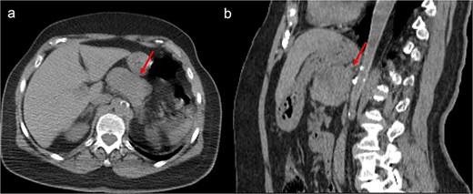 Unenhanced CT scan, axial (a), and sagittal reconstruction (b), revealing a well-defined oval mass with regular contours and soft-tissue density, closely contacting the posterior wall of the stomach and appearing to occupy the omental bursa. The lesion does not invade adjacent structures.