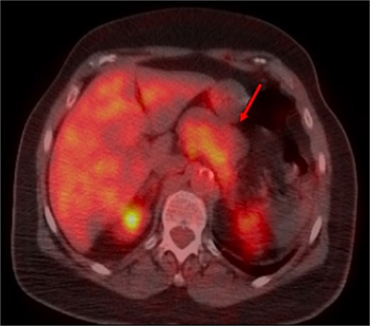 FDG PET scan demonstrating hypermetabolism of the mass.
