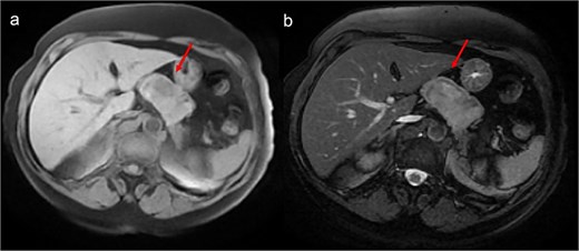 Abdominal MRI showing a heterogeneous intermediate T1 signal mass (a) with slight hyperintensity on T2-weighted images (b), without fatty components, closely contacting the stomach but distant from the liver.