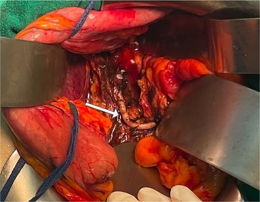 Intraoperative view after complete resection of the mass, showing displacement of the splenic artery (arrow).