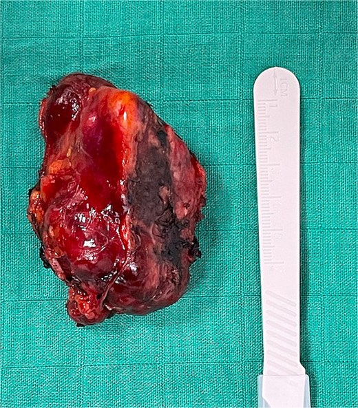 Surgical specimen.