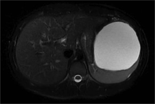 Axial view or preoperative MRI of splenic cyst, diameter of 13 cm.