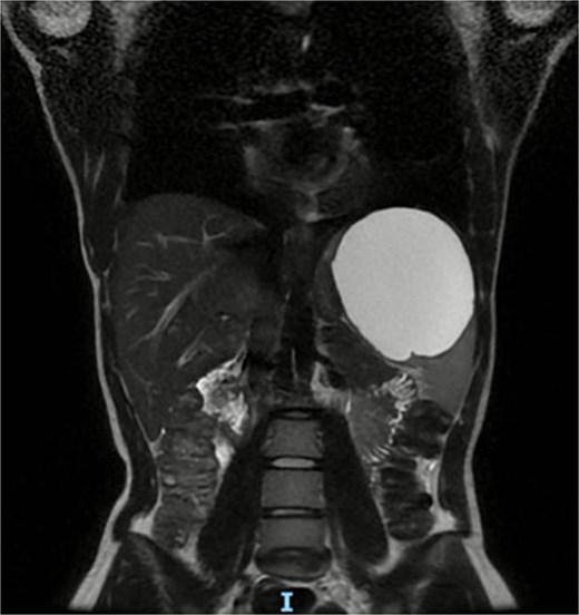 Coronal view or preoperative MRI of splenic cyst.