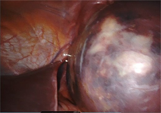 Intraoperative visualization of enlarged spleen and intraparenchymal cyst.