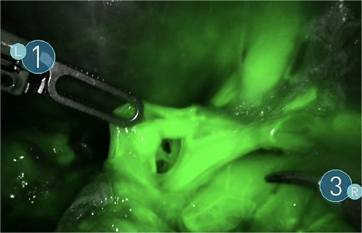 Use of ICG enhanced fluorescence for adequate visualization of splenic hilum.