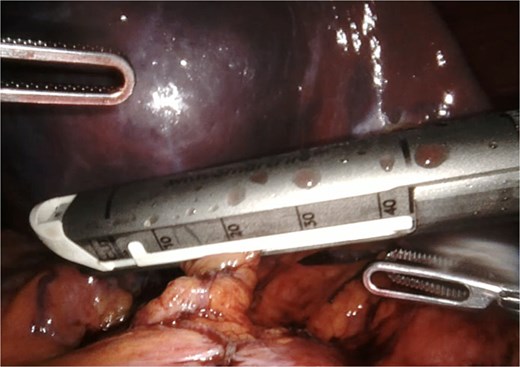 Vascular laparoscopic stapler for hilum control.