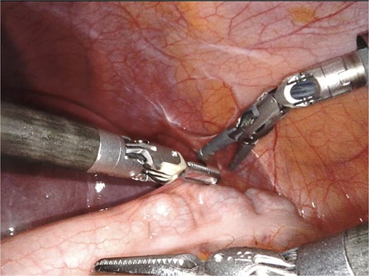 Section of the spleno-colic ligament with bipolar forceps.