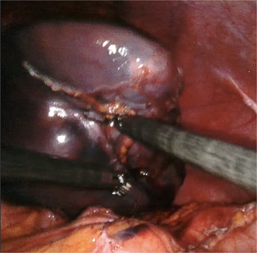 Adequate mobilization of the spleen.