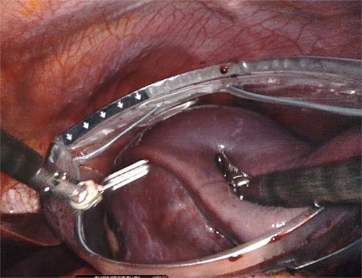 Placement of the spleen in large laparoscopic retrieval bag without rupture of the specimen.