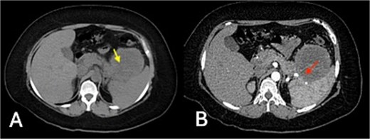 Triple-phase contrast-enhanced CT of the upper abdomen: (A) non-contrast phase showing an exophytic, well-defined, lobulated lesion of the gastric fundus (83 × 72 × 79 mm) with isodense attenuation (20 HU) (yellow arrow); (B) arterial phase revealing mild heterogeneous enhancement (up to 35 HU) and central hypodensity, with loss of interface between the mass, pancreatic tail, and spleen (red arrow indicates area of interface loss).