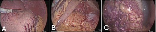 Intraoperative laparoscopic views: (A) stomach in situ before dissection; (B) exposure after mobilization of the greater curvature; (C) dissection of the hepatoduodenal ligament and pancreatic head.