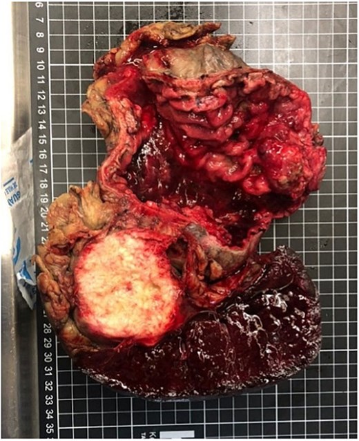 Gross specimen showing an exophytic, ulcerated distal gastric tumor (6 × 6 × 3.5 cm) and a solid lesion in the pancreatic tail (6 × 3.5 × 2 cm), both in continuity.