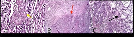 Histopathology: (A) neoplastic squamous cells with eosinophilic cytoplasm, well-defined borders, oval nuclei, prominent nucleoli, and keratin pearl formation (H&E, ×40) (yellow arrow); (B) tumor invasion into mucosa and submucosa (red arrow); (C) adjacent gastric glands without atypia (black arrow).