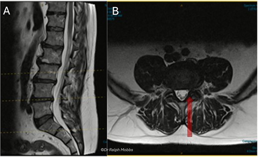 Case 1 mid-sagittal (A) and axial (B) T2-weighted MRI at L4/5 with lateral recess stenosis (arrow).